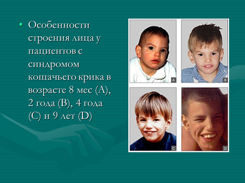 Особенности строения лица у пациентов с синдромом кошачьего крика в возрасте 8 мес (A),